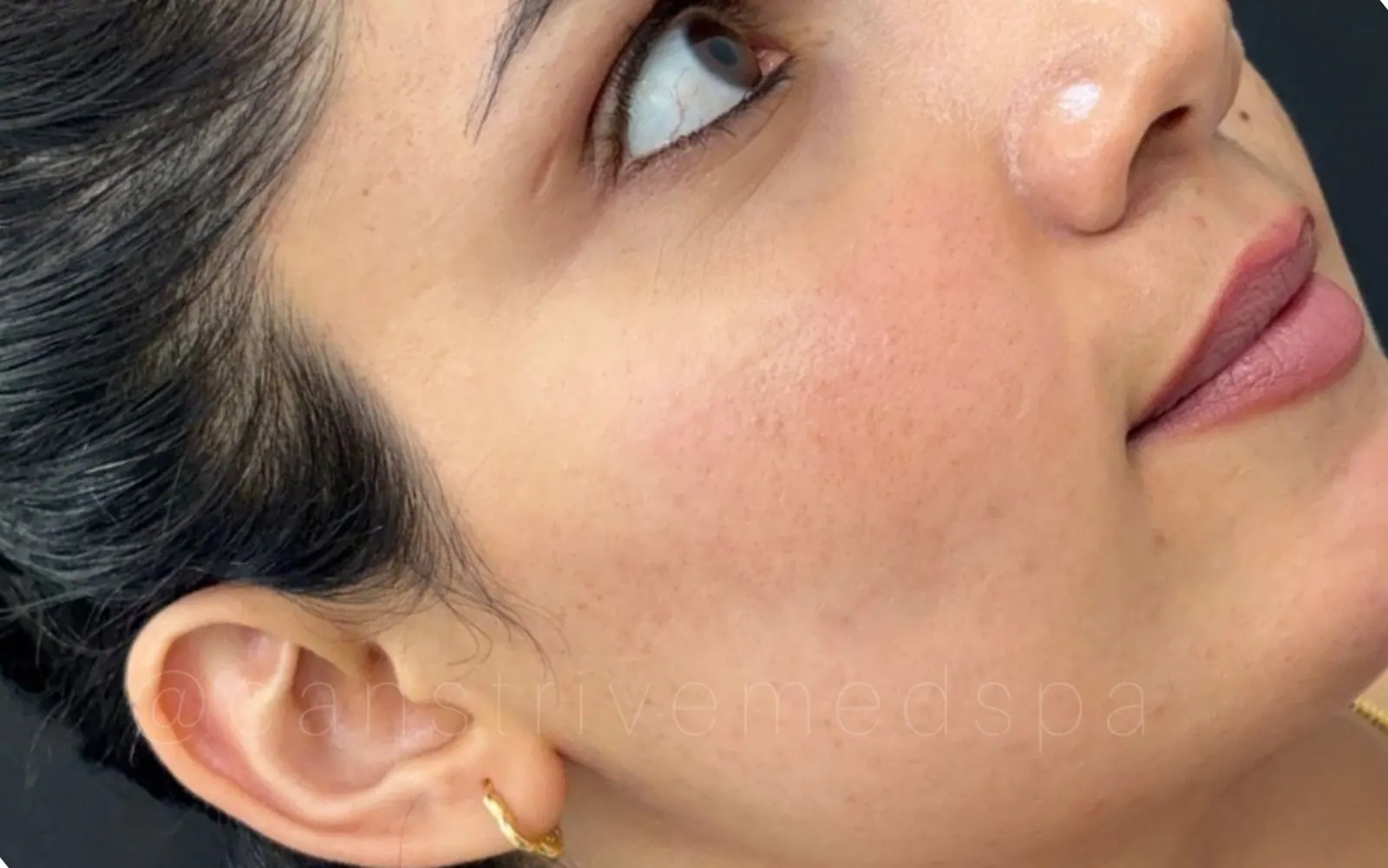 Featured acne result, before and after