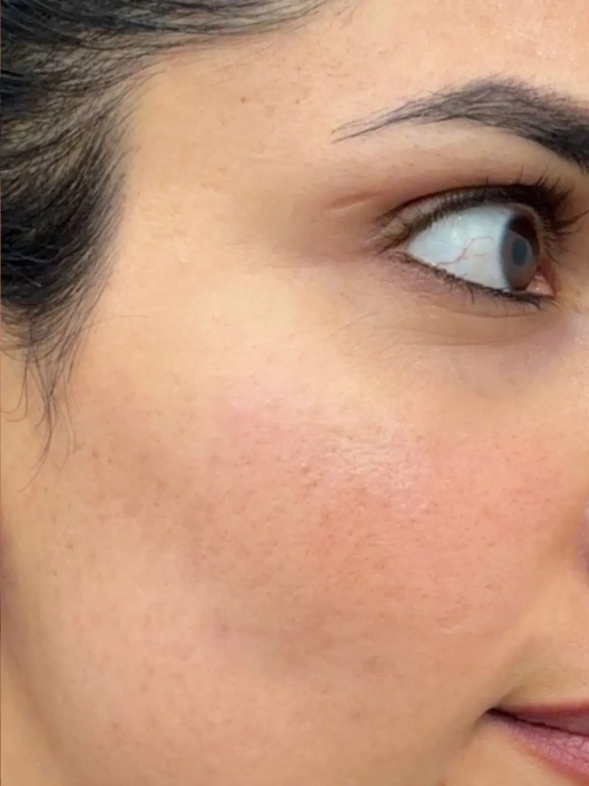Cystic Acne Clearance, before and after