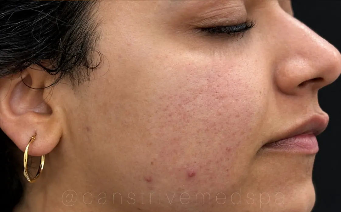 Active Breakouts Calmed, before and after