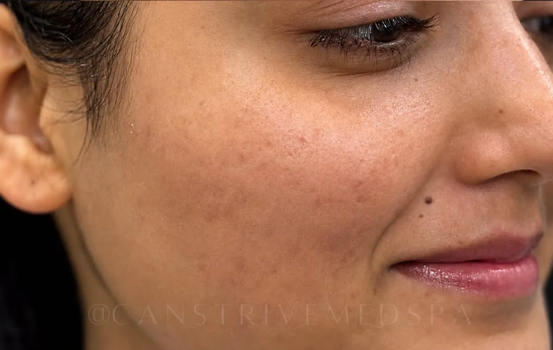Cheek Acne & Redness Reduced, before and after
