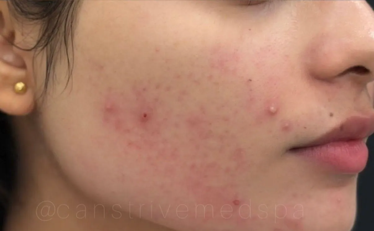 Inflamed Breakouts Calmed, before and after