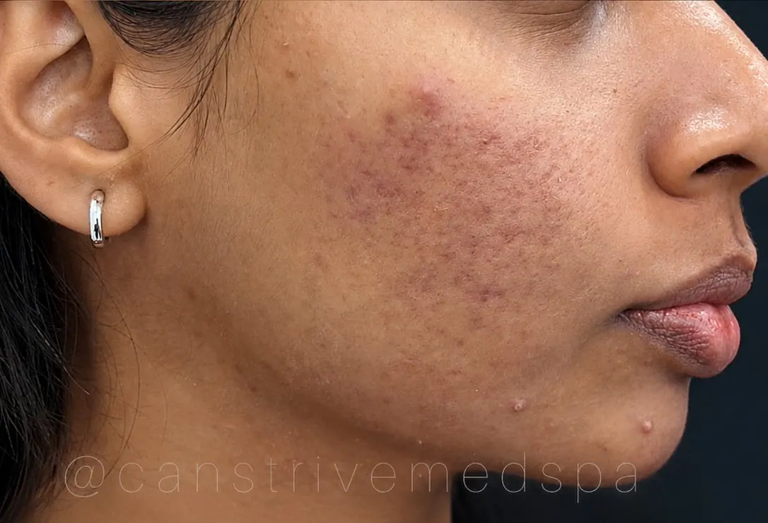 Breakouts & Dark Marks Reduced, before and after