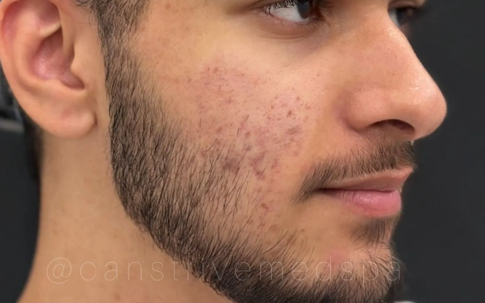 Cheek & Jawline Acne Cleared, before and after