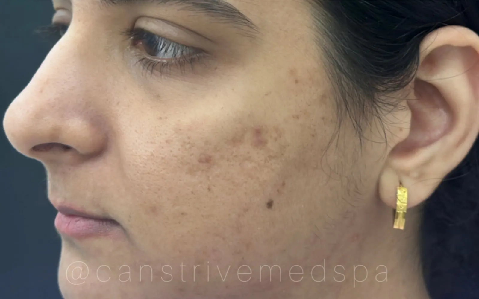 Acne & Marks Faded, before and after