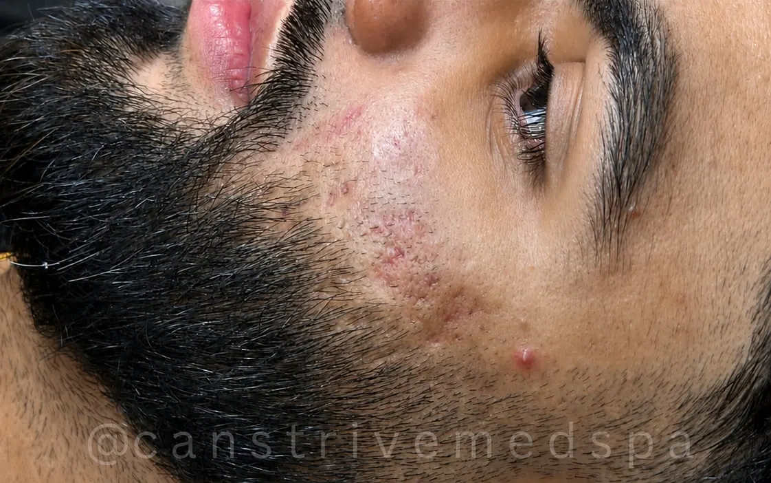 Cheek Breakouts Calmed, before and after