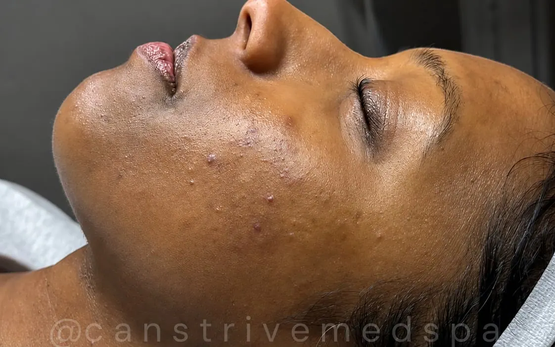 Bumpy Breakouts Smoothed, before and after