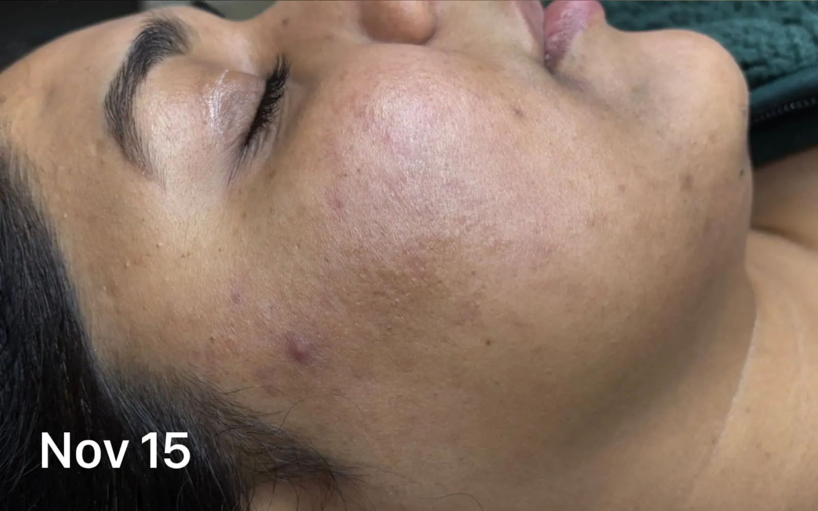 Clearer, Calmer Skin, before and after