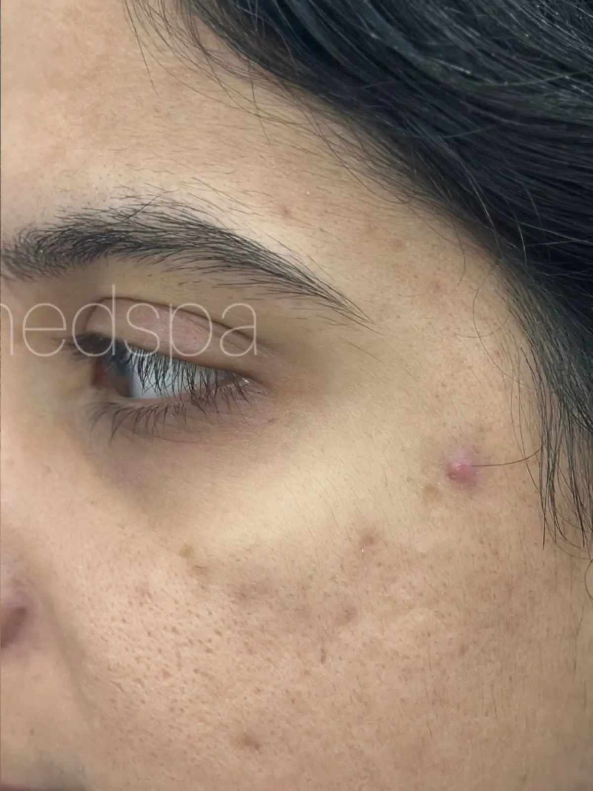 Post-Acne Marks Faded, before and after