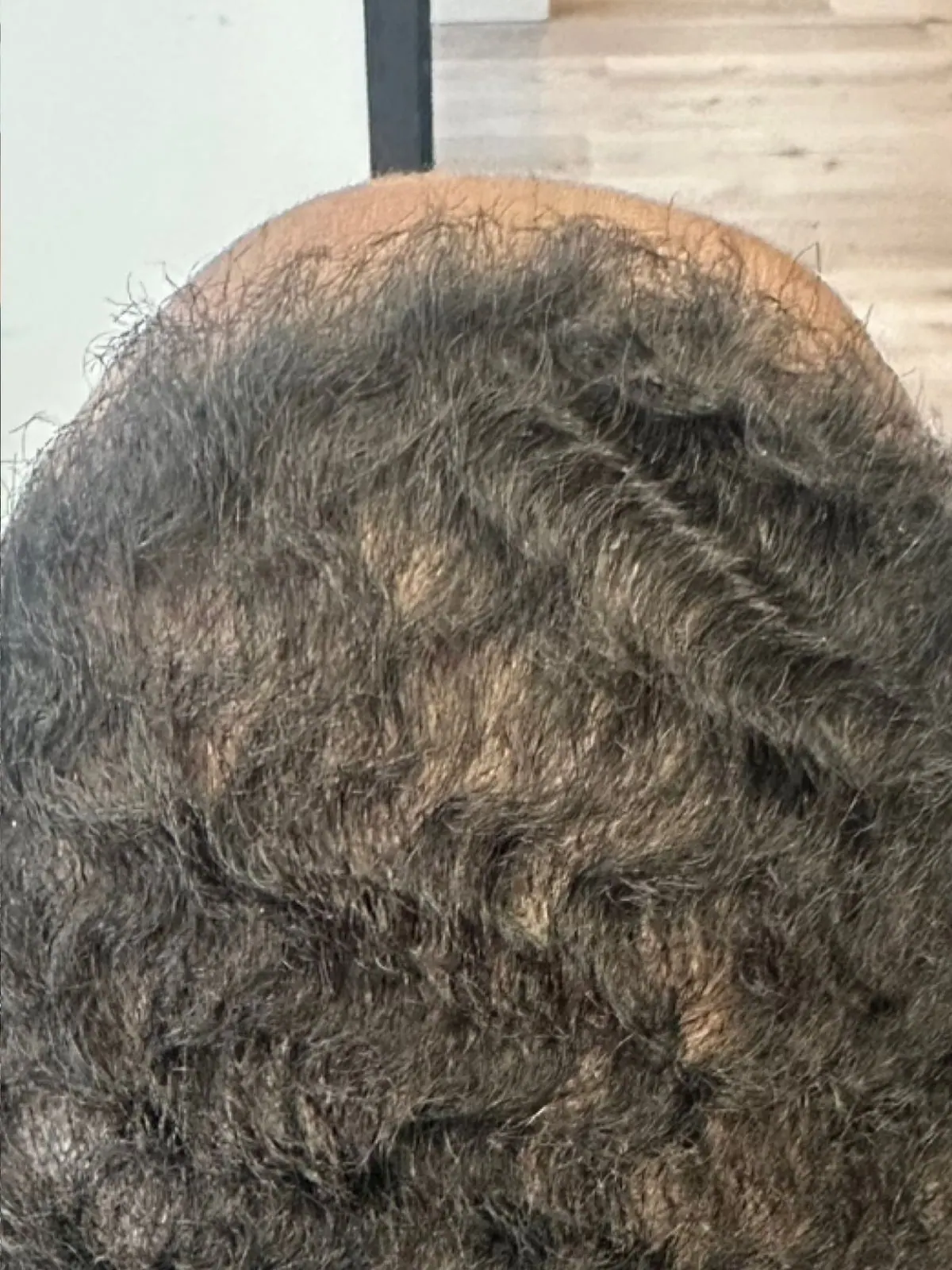 Scalp Coverage Improved, before and after