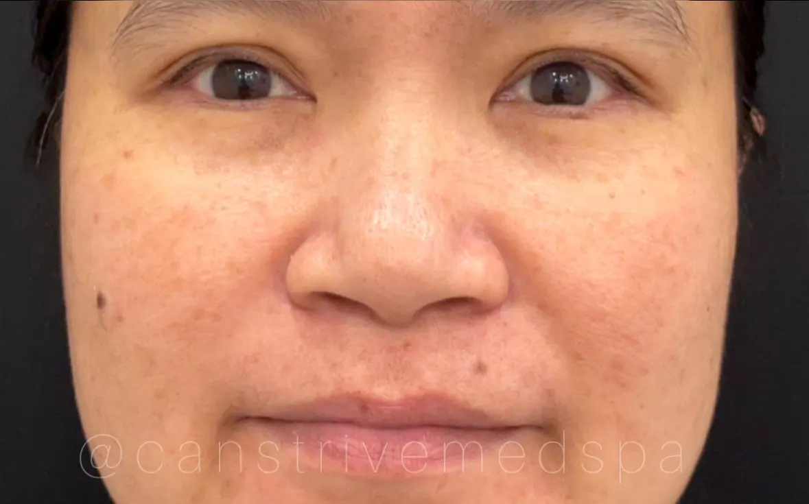 Melasma & Sun Spots Lightened, before and after