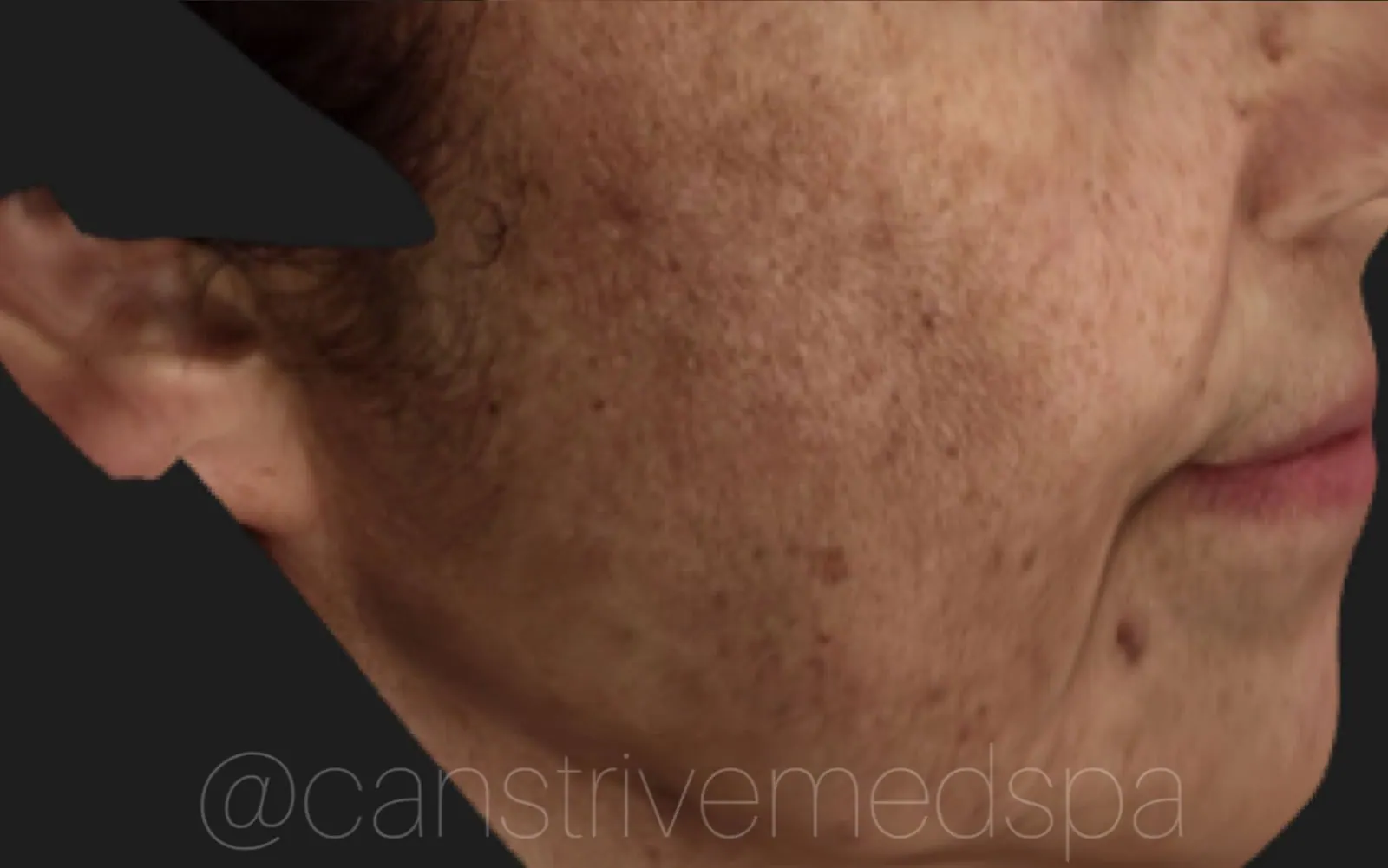 Deep Melasma Lightened, before and after