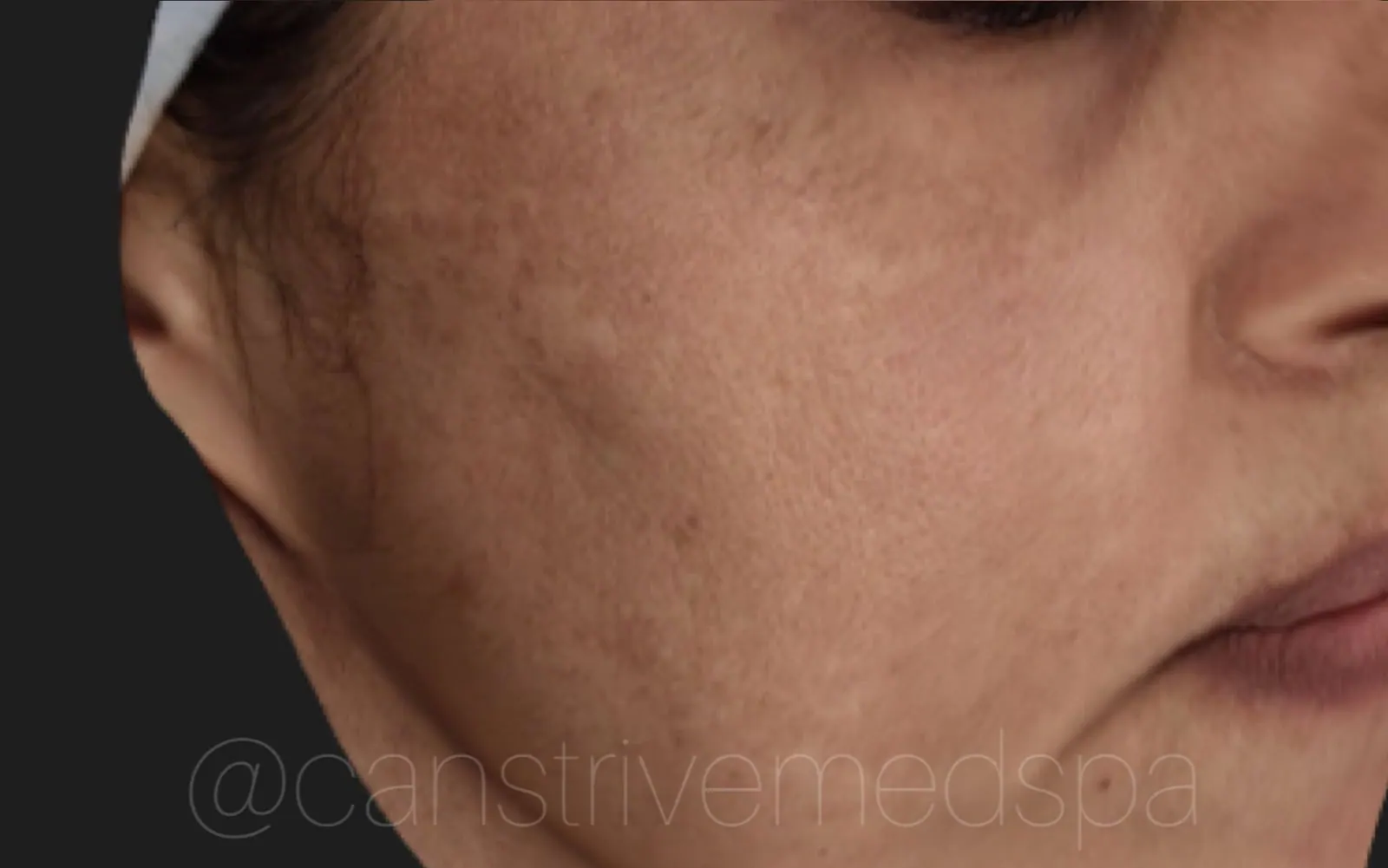 Cheek Pigmentation Evened, before and after