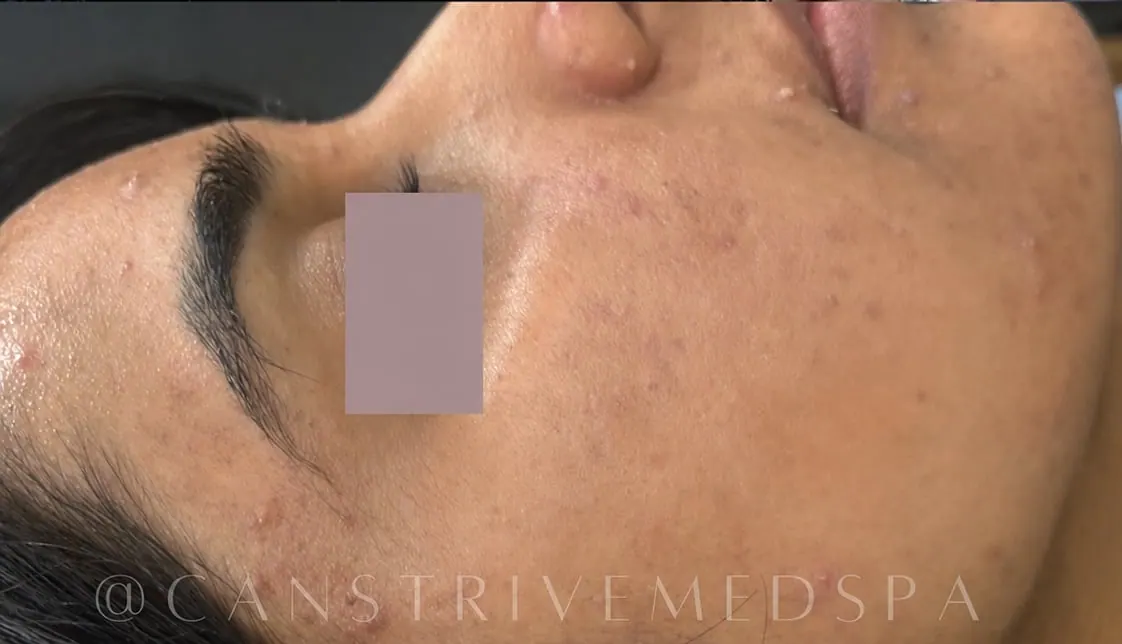 Pigmentation & Breakouts Cleared, before and after
