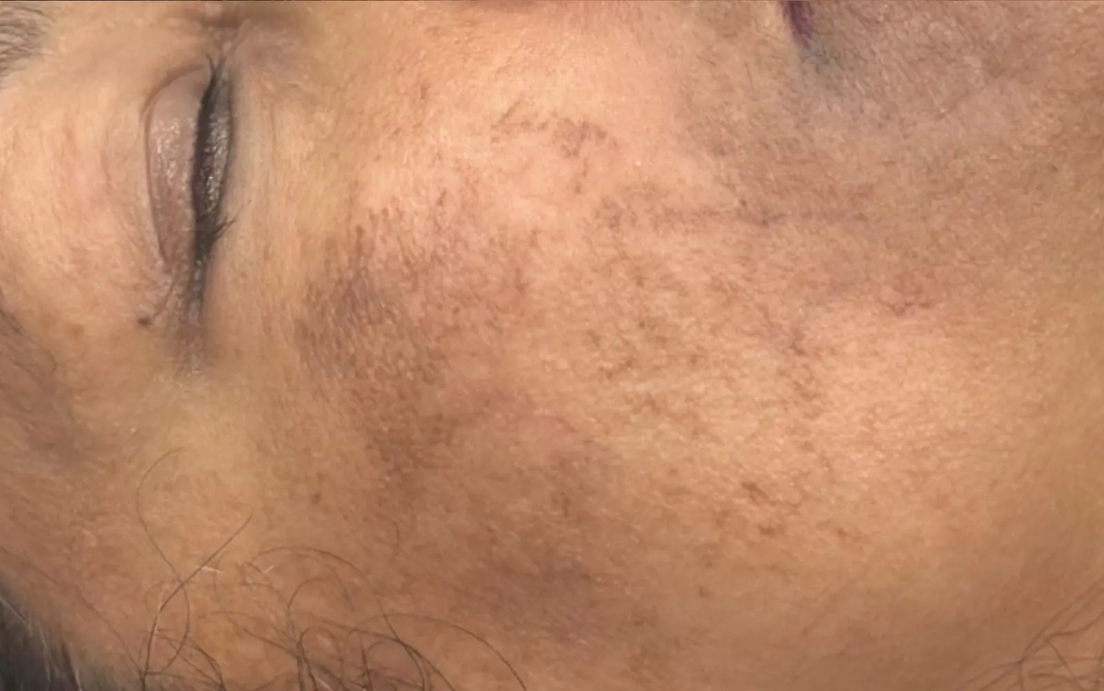 Dark Patches Lightened, before and after