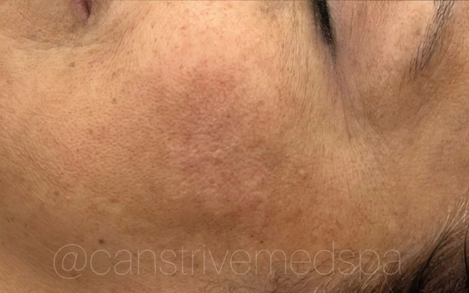 Redness & Pigment Reduced, before and after
