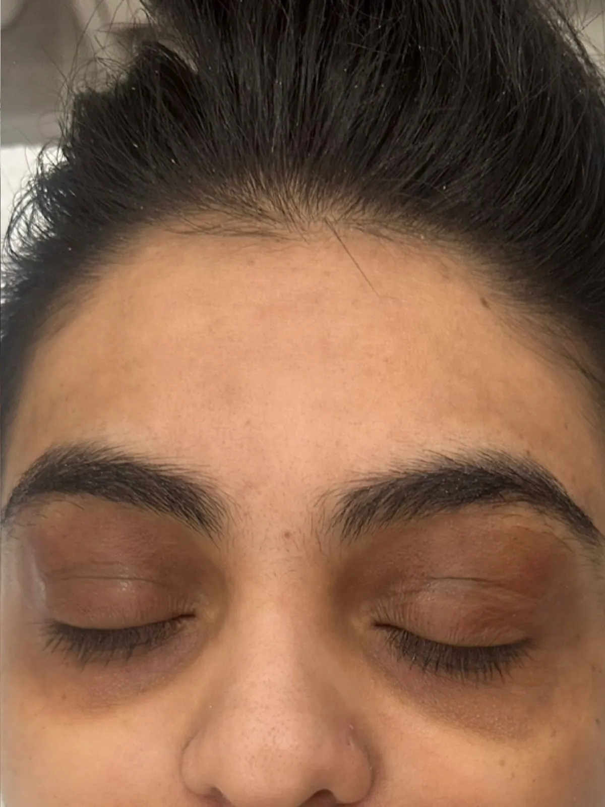 Under-Eye Darkness Brightened, before and after